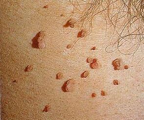 inimese papilloomiviirus nahal