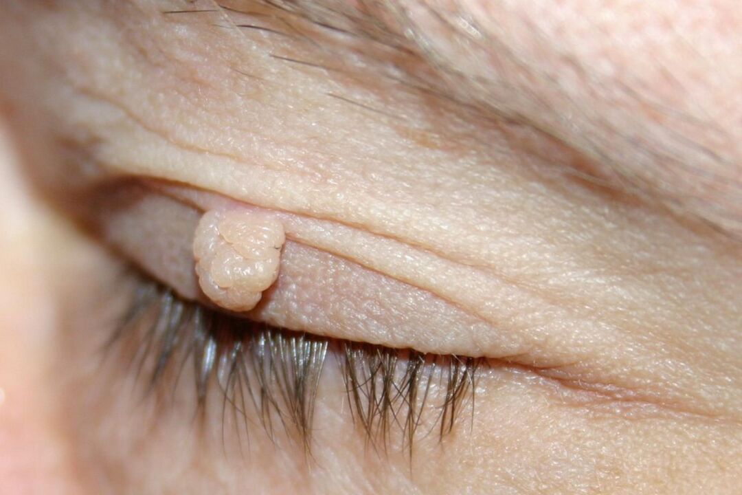 papilloomide sümptomid silmalaul
