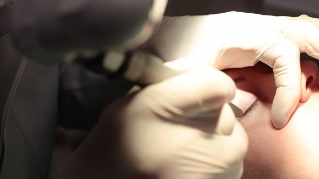 Silmalau papilloomi eemaldamine laseriga